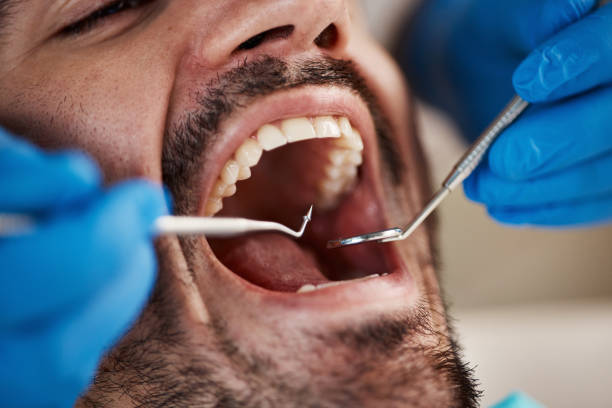 Best Emergency Wisdom Teeth Removal in Big Bass Lake, PA